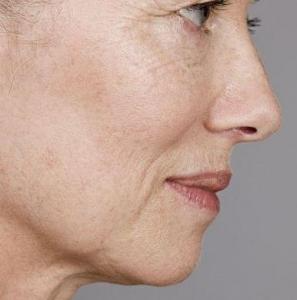 Photoaging & Texture Renewal