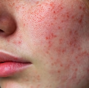 Pigment & Tone Correction