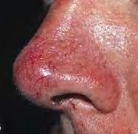 Rhinophyma Debulking & Nasal Contour